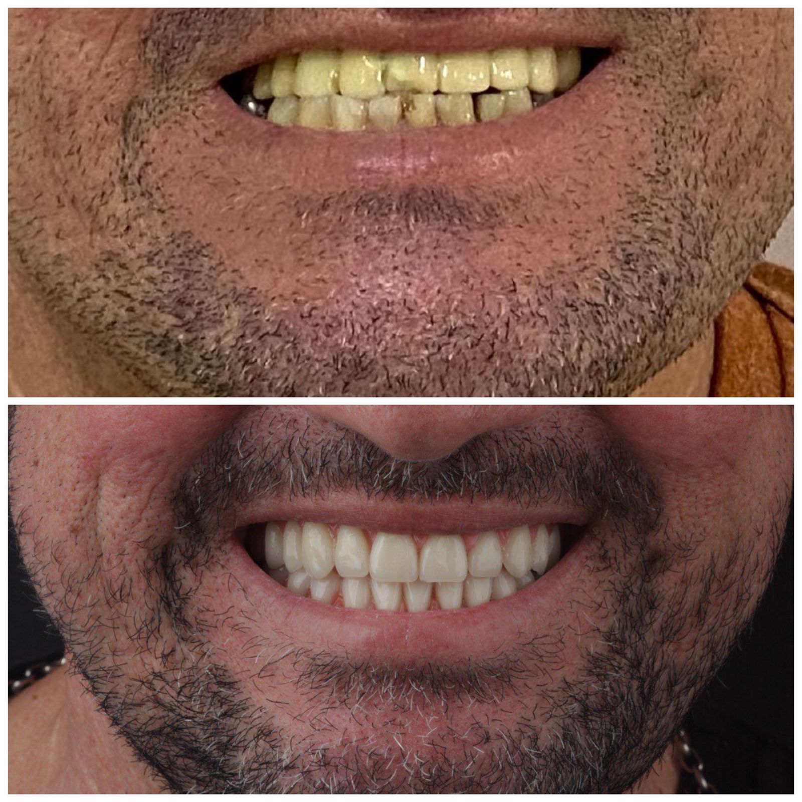 Paciente antes e depois da prótese protocolo
