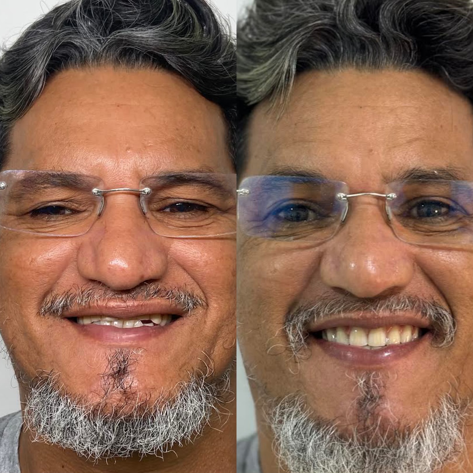 Paciente antes e depois da prótese fixa sobre implantes