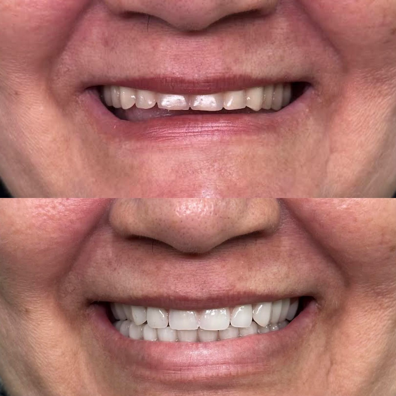 Paciente antes e depois da prótese fixa sobre implantes