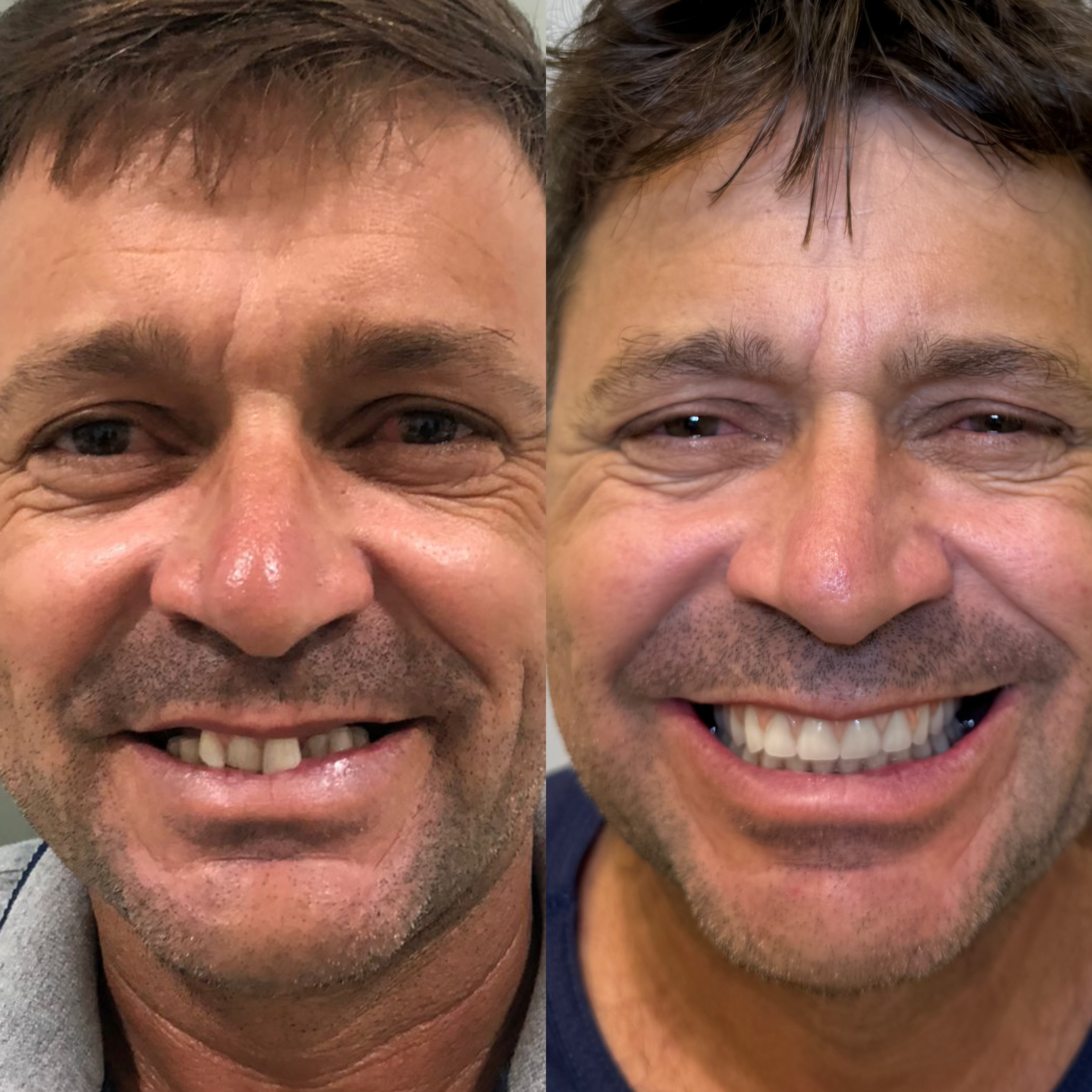 Paciente antes e depois da prótese fixa sobre implantes