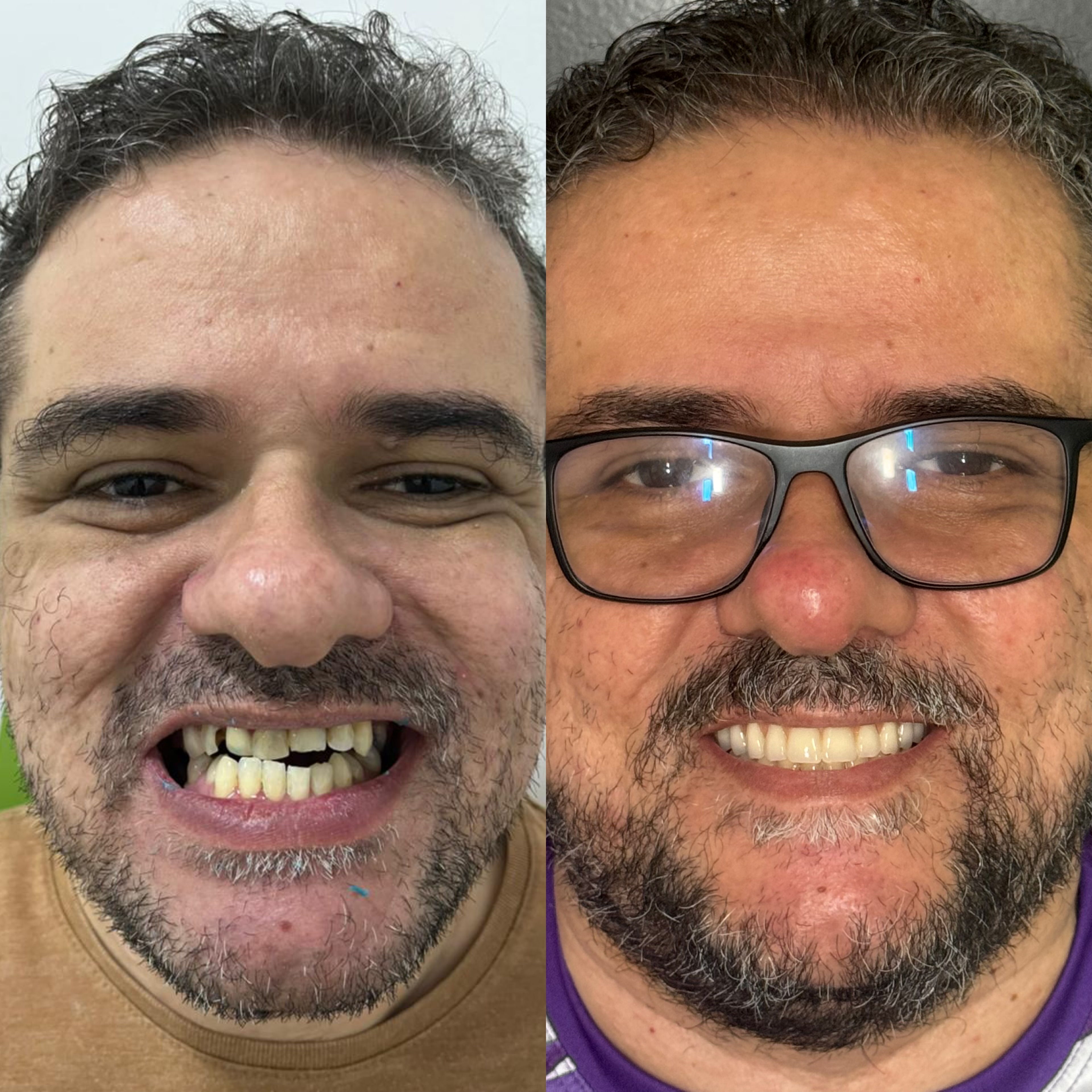 Paciente antes e depois da prótese fixa sobre implantes