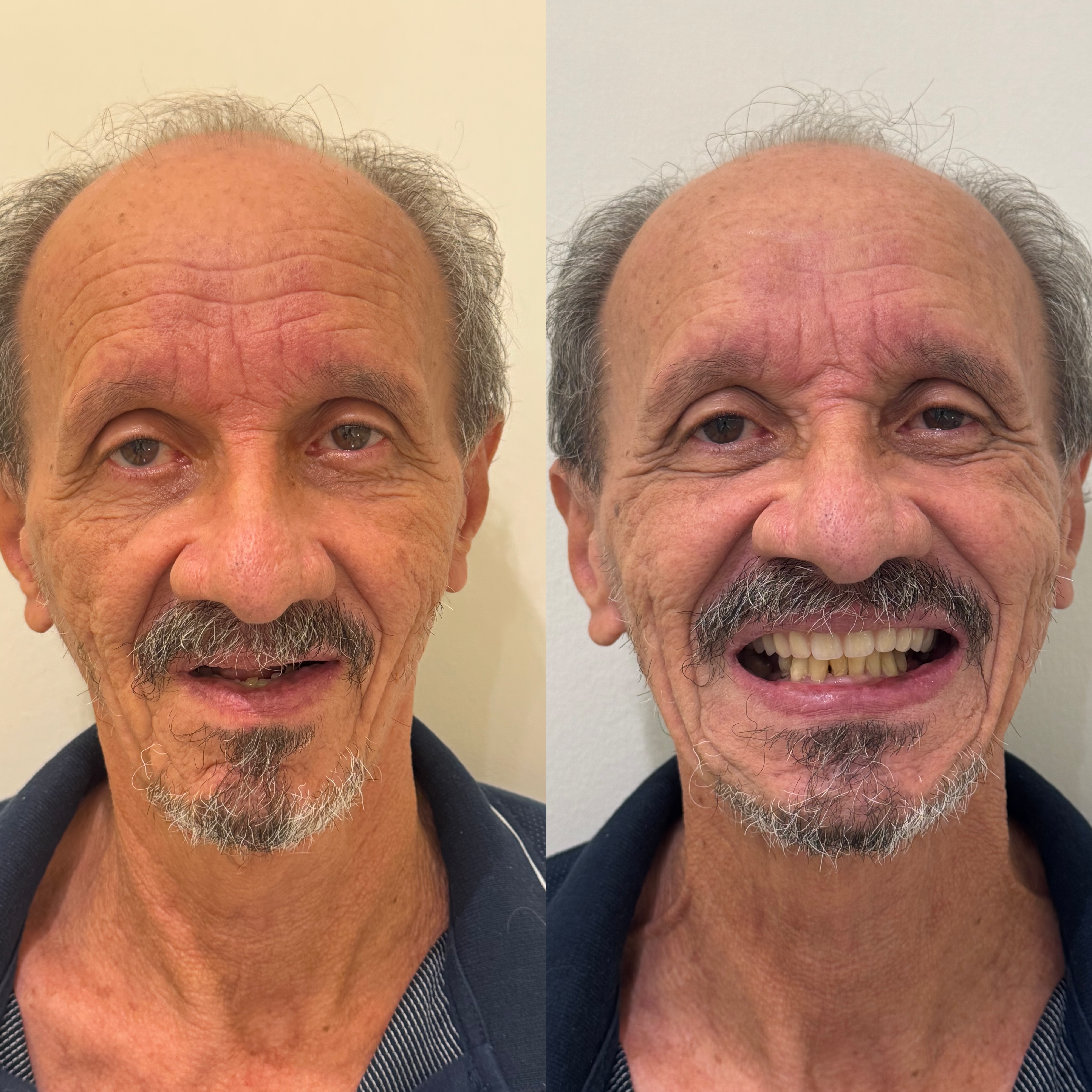 Paciente antes e depois da prótese protocolo